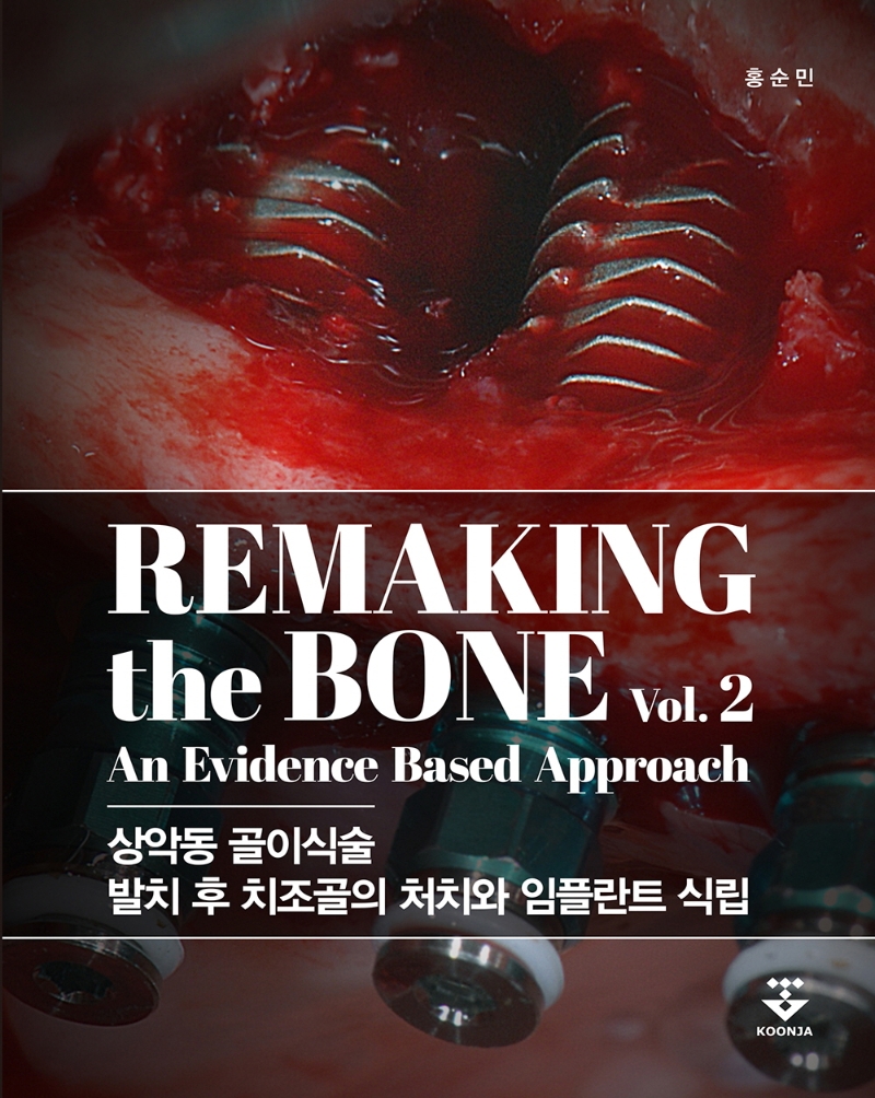 Remaking the bone : an evidence based approach. v.2, 상악동 골이식술 발치 후 치조골의 처치와 임플란트 식립