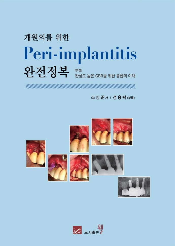 (개원의를 위한) peri-implantitis 완전정복