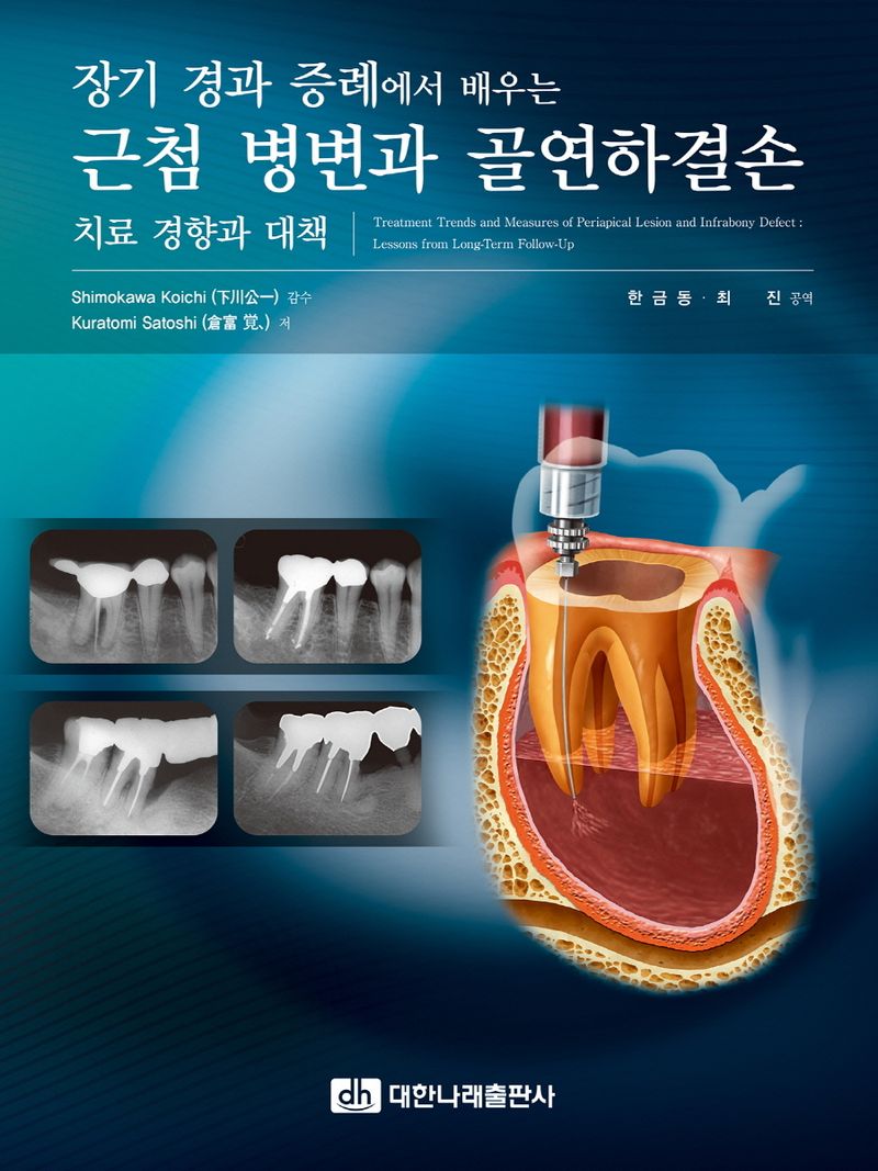 (장기 경과 증례에서 배우는) 근첨 병변과 골연하결손 : 치료 경향과 대책 = Treatment trends and measures of periapical lesion and infrabony defect : lessons from long-term follow-up