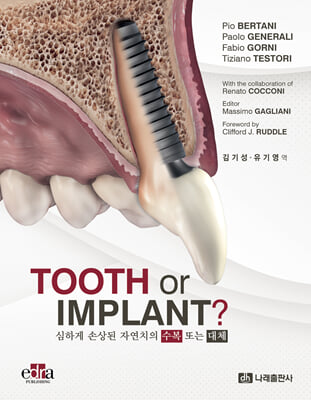 Tooth or implant? [전자자료] : 심하게 손상된 자연치의 수복 또는 대체